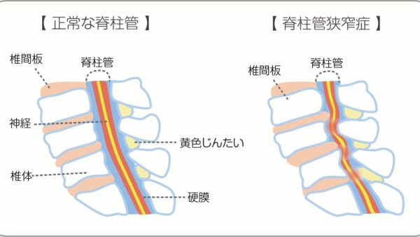 脊柱管狭窄症とは？歩くと足がしびれる原因と対策｜てて整骨院二十四軒店