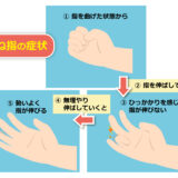 ばね指でお困りの方へ｜札幌市西区二十四軒のてて整骨院二十四軒店