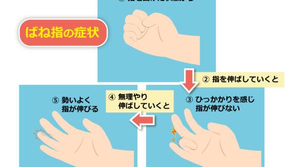 ばね指でお困りの方へ｜札幌市西区二十四軒のてて整骨院二十四軒店